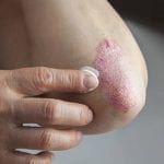 Psoriasis, der Schrecken vieler Organe