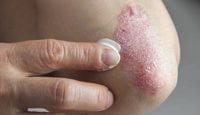 Psoriasis, der Schrecken vieler Organe