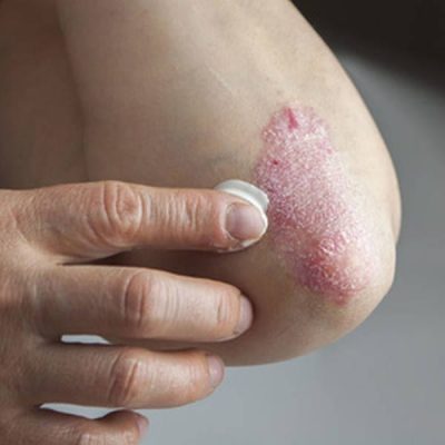 Psoriasis, der Schrecken vieler Organe