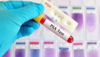 Prostatakrebs: Wie effektiv sind PSA-Tests?