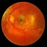 Makuladegeneration: Pflanzenstoffe versprechen Hilfe