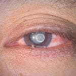 Risiko durch Cholesterinsenker: Verschlechterung der Sehkraft