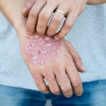 Metabolisches Syndrom als Folge von Psoriasis?