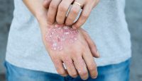 Metabolisches Syndrom als Folge von Psoriasis?