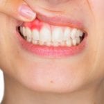 Entzündetes Zahnfleisch: entzündete Gelenke