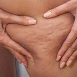 Wie Sie Cellulite effektiv bekämpfen