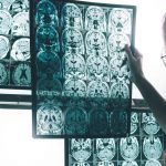 Lichttherapie: Die Antwort auf Alzheimer?