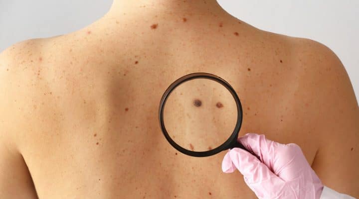 Vitamin B3 könnte Ihr Hautkrebsrisiko um die Hälfte senken