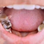 Auf Wiedersehen, Karies? Diese neue Zahnpasta aus Haaren könnte die Lösung sein