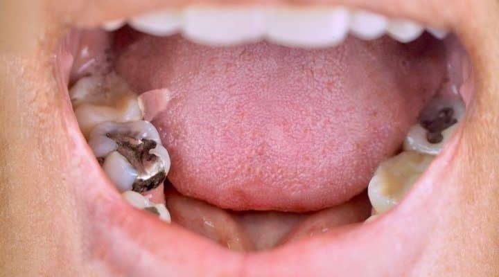 Auf Wiedersehen, Karies? Diese neue Zahnpasta aus Haaren könnte die Lösung sein