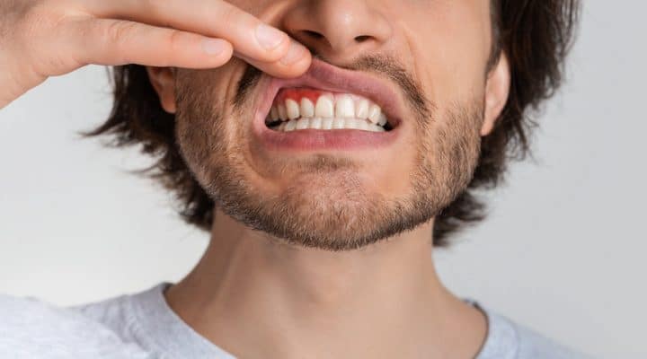 Kann Fasten Zahnfleischerkrankungen bekämpfen? Forscher entdecken einen überraschenden Zusammenhang